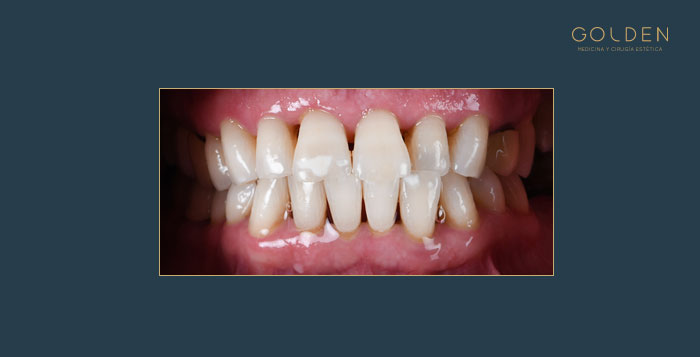 After-periodoncia