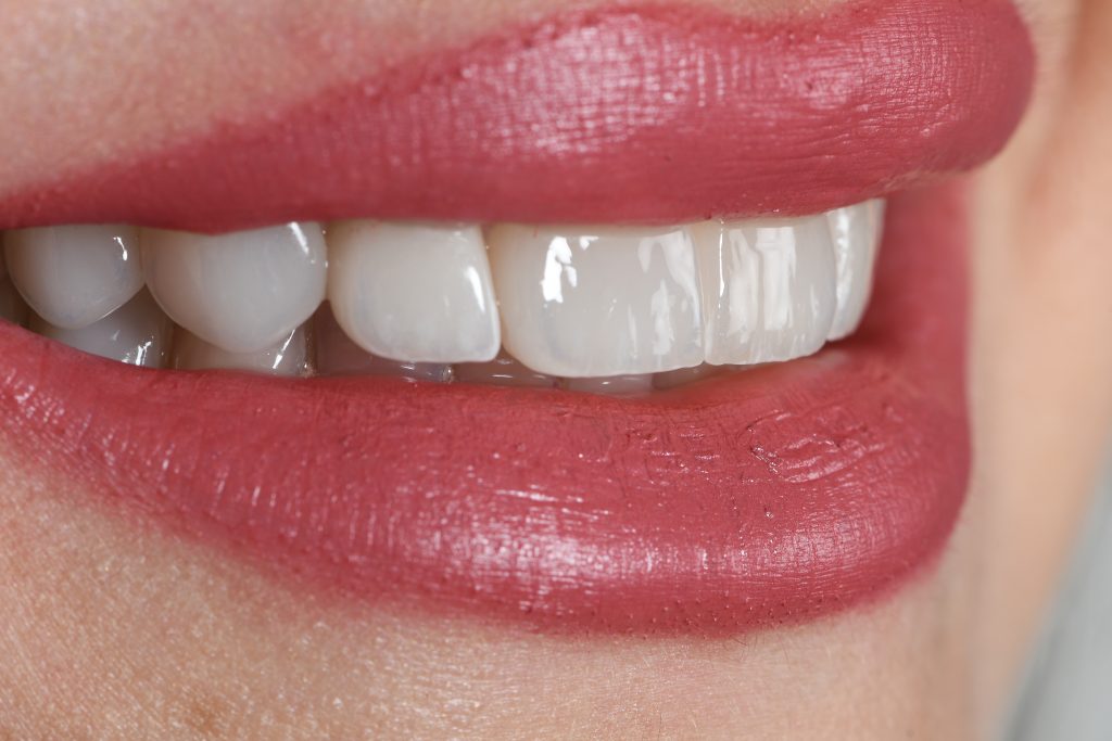 Carillas Dentales en Sevillla