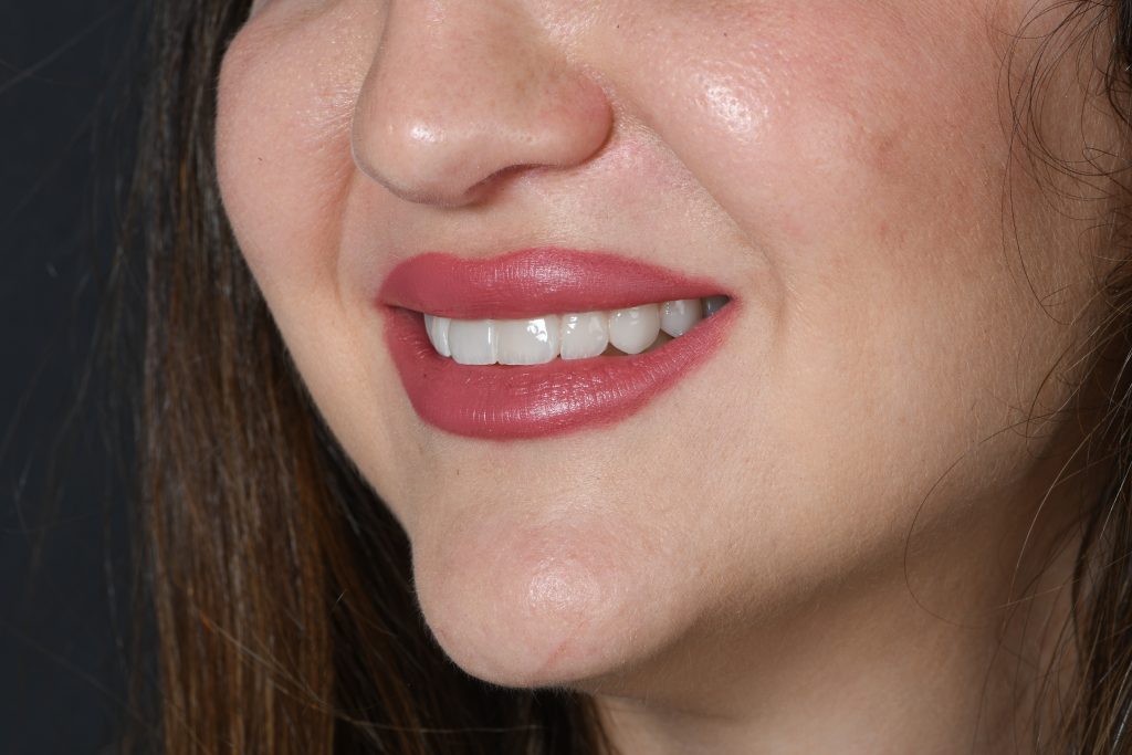 Carillas Dentales en Sevillla