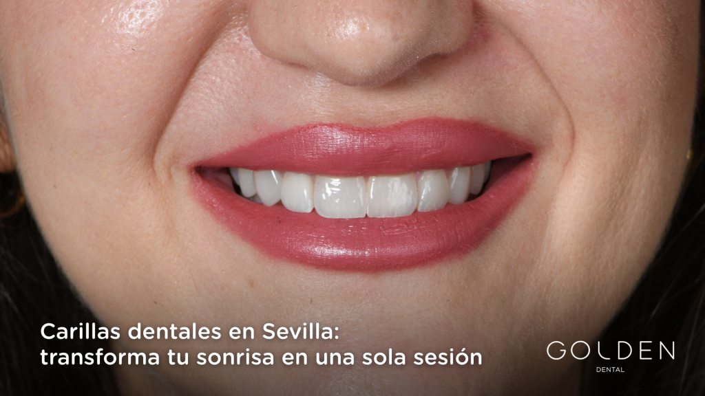 Carillas dentales