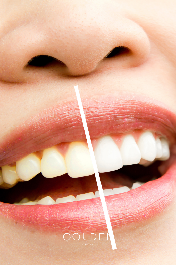 blanqueamiento dental