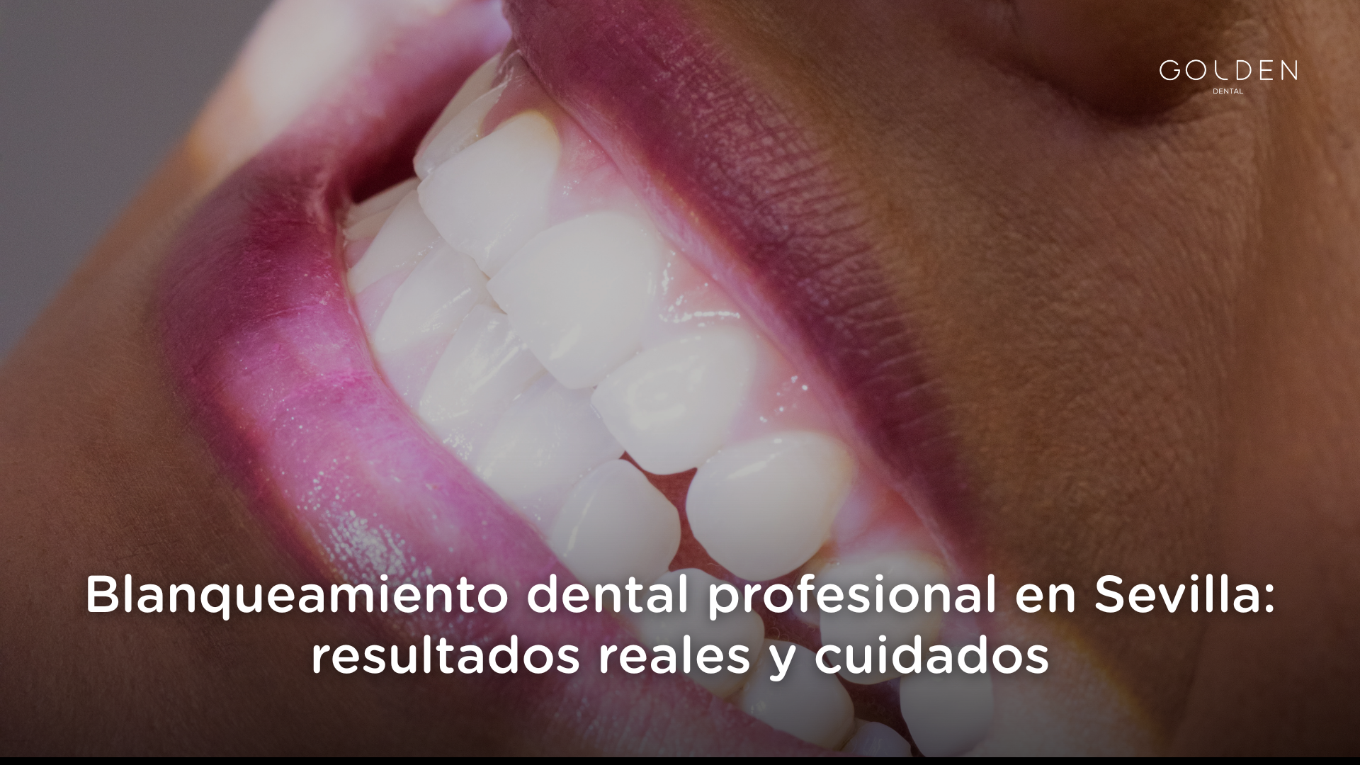 blanqueamiento dental en Sevilla