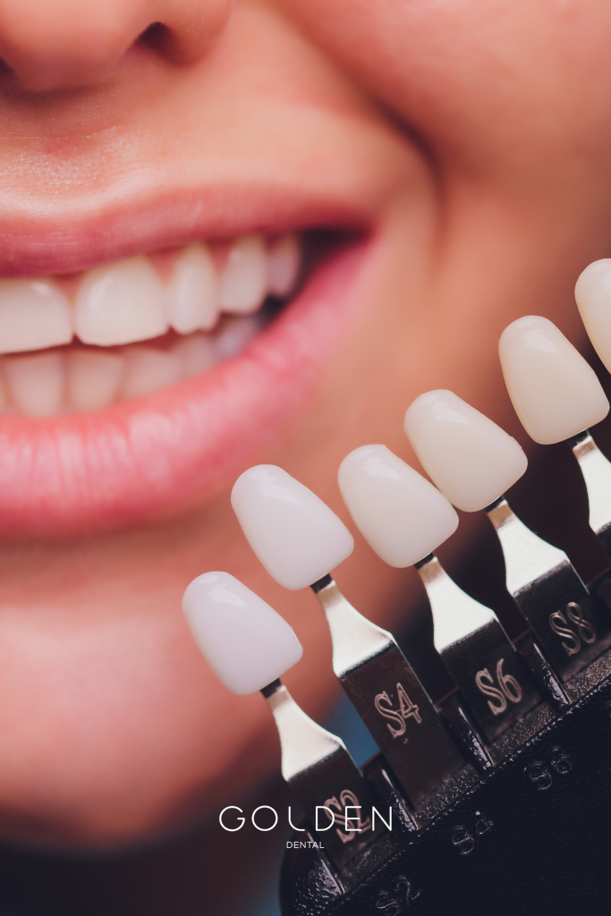 carillas dentales en Sevilla