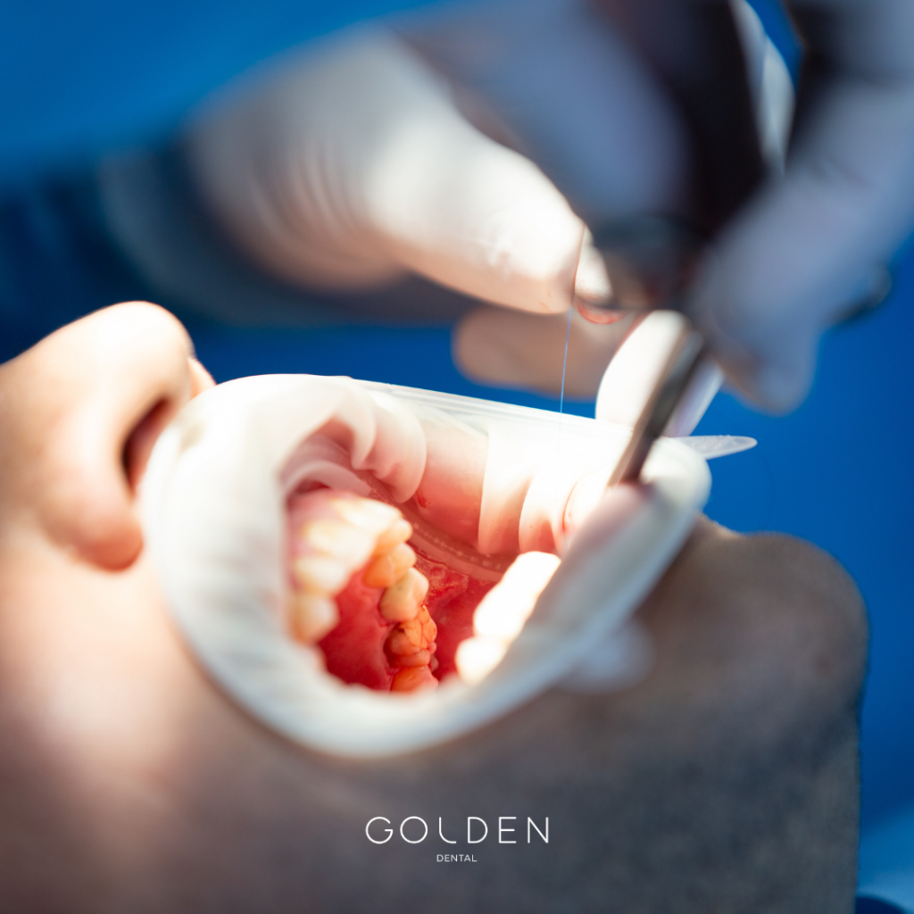 injertos dentales Sevilla