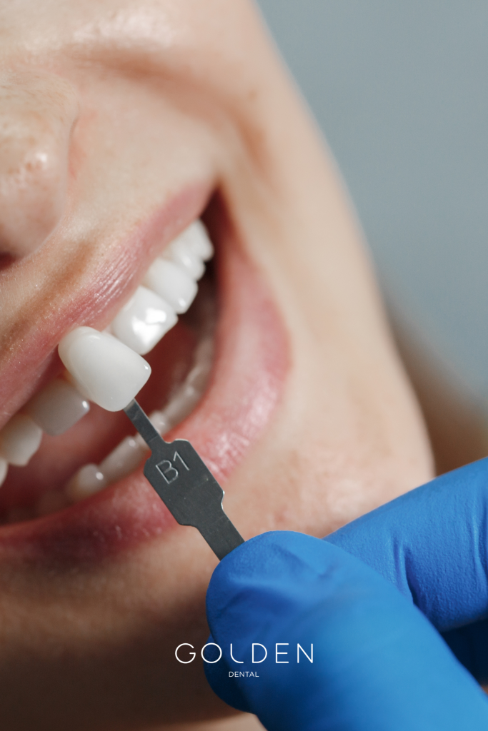 carillas dentales Sevilla