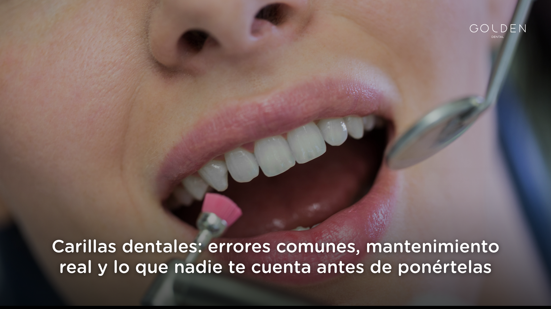 carillas dentales Sevilla