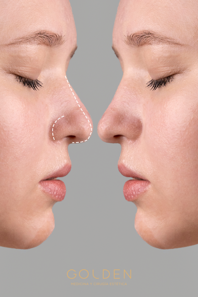 rinomodelación sin cirugía