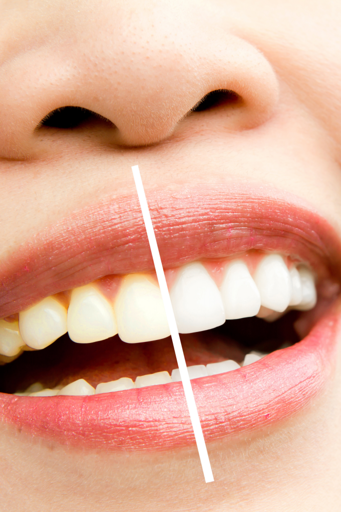 blanqueamiento dental Sevilla