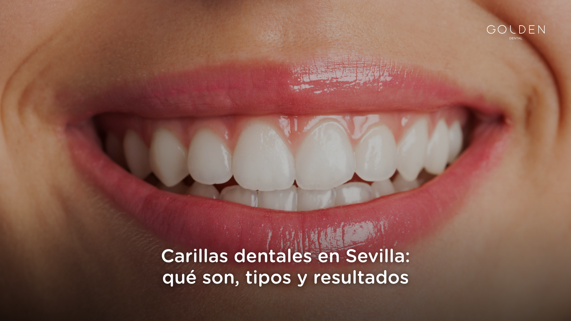 carillas dentales en Sevilla