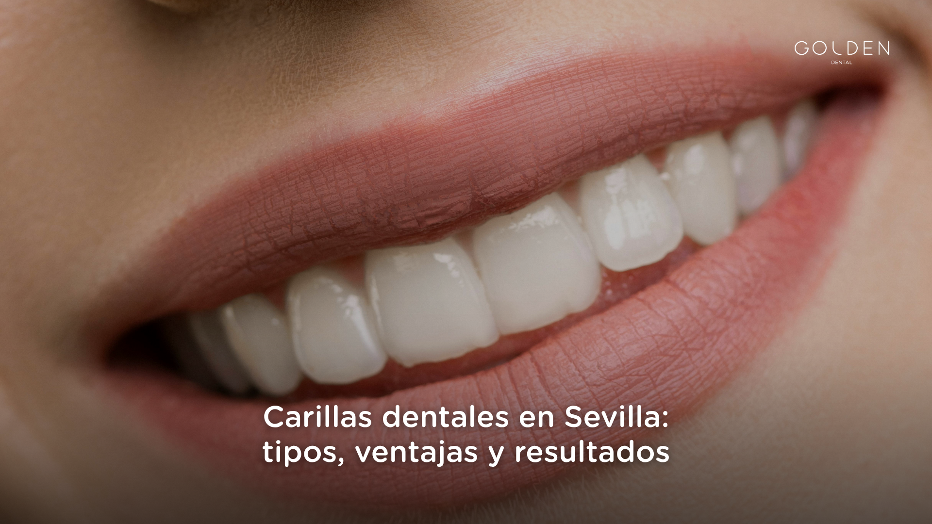 carillas dentales Sevilla