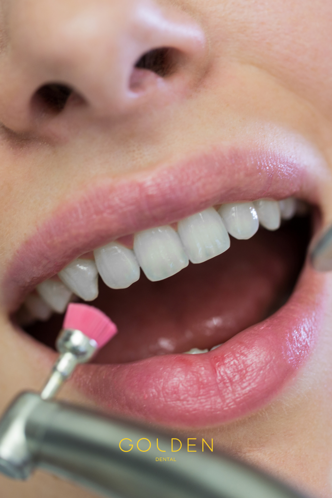 limpieza bucal profesional en Sevilla